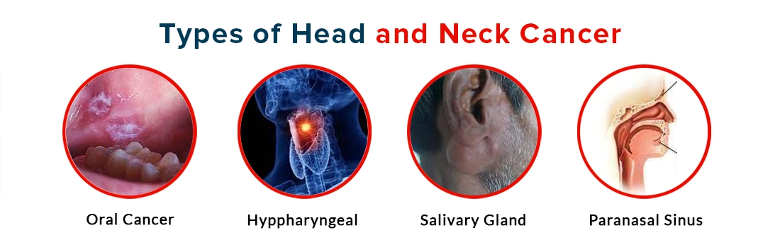 Types of Head and Neck Cancer